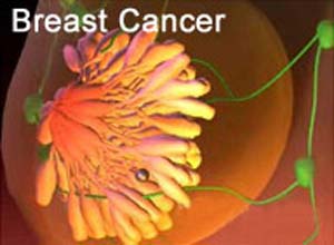 همه ژن های موثر در بروز سرطان سینه شناسایی شدند