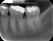کشیدن دندان طمع دندانپزشکان قلابی در لردگان