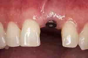 ایمپلنت بخش مهمی از درمان‌های پروتزی دندان است