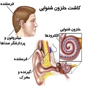 کاشت حلزون گوش بدون نوبت در اردبیل