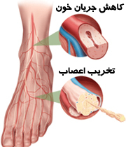 نوروپاتی دیابتی چیست؟