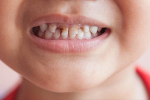 حدود ۹۰ درصد کودکان ۶ ساله، دچار پوسیدگی دندان