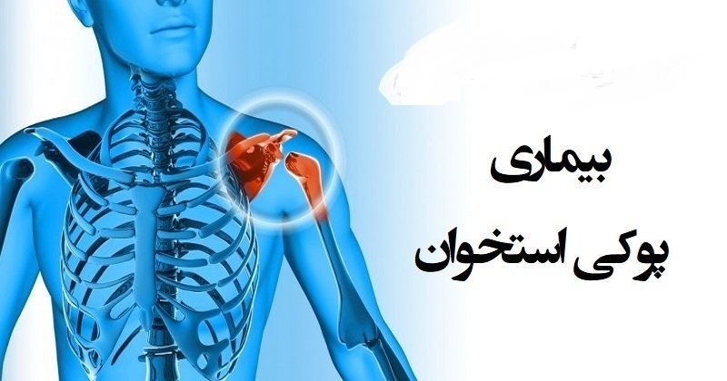 نشانه‌های هشداردهنده پوکی استخوان کدامند؟