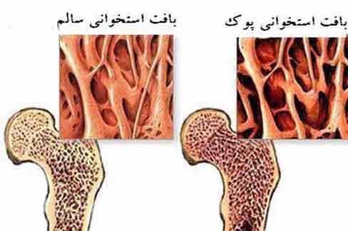 پوکی استخوان بیماری قابل پیشگیری ---یکشنبه