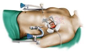 عمل جراحی کم تهاجمی قلب در بیمارستان افشار یزد