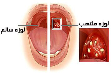 چه وقت لوزه کودکان نیازمند جراحی است؟