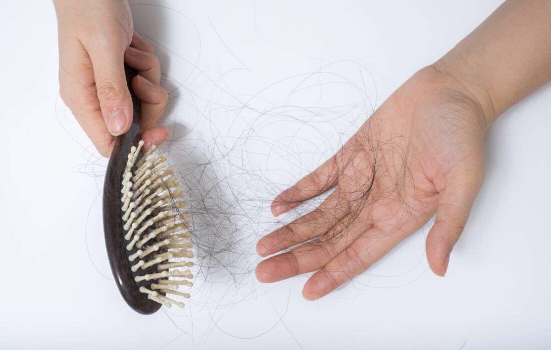رایج‌ترین توجیه‌های پزشکی ریزش مو
