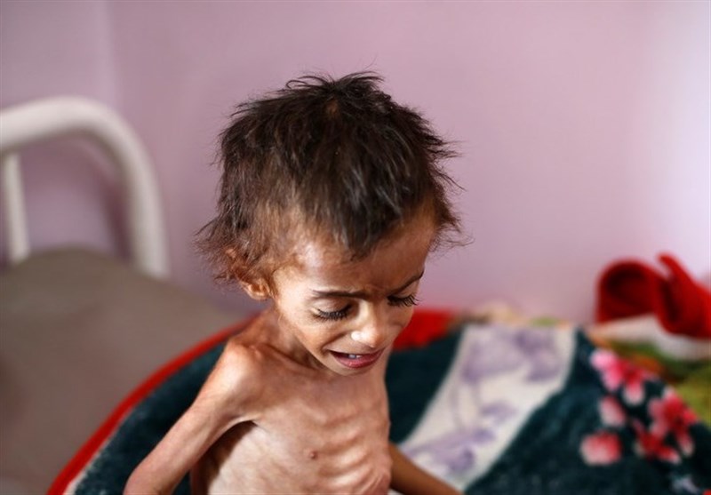 سوء تعذیه شدید نیمی از کودکان یمن