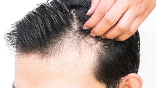 راهکار‌های طب سنتی برای جلوگیری از «ریزش مو»