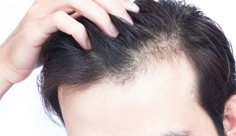 طب سنتی چه راهکارهایی جهت جلوگیری از ریزش مو دارد؟