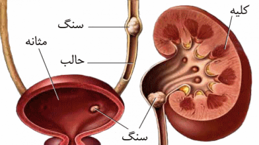 عواملی که باعث ایجاد سنگ کلیه می‌شود