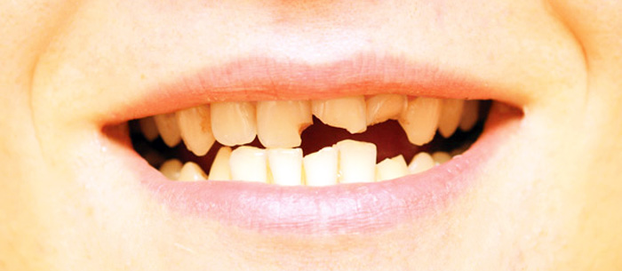 علت شکستن ناگهانی دندان چیست؟