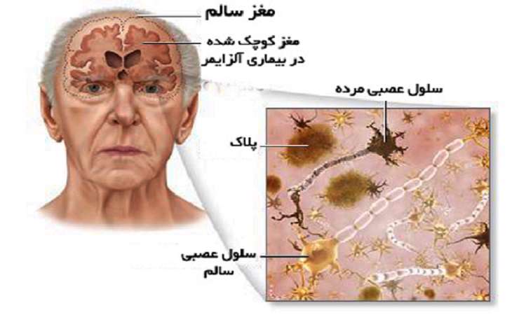 علائم اولیه آلـزایمـر را بشناسید