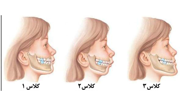 ۸ درصد کودکان از ناهنجاری فک رنج می‌برند