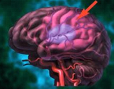 شش گام برای پیشگیری از احتمال ابتلاء به سکته مغزی
