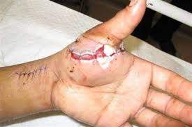 پیوند موفقیت آمیز انگشت قطع شده یک بیمار در میناب