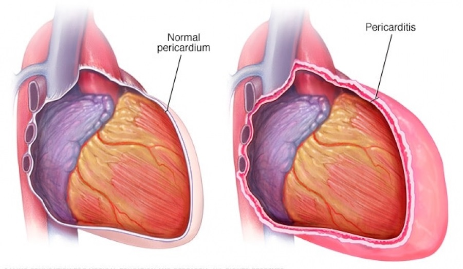 تجمع مایع اطراف قلب؛ از دلایل تا درمان