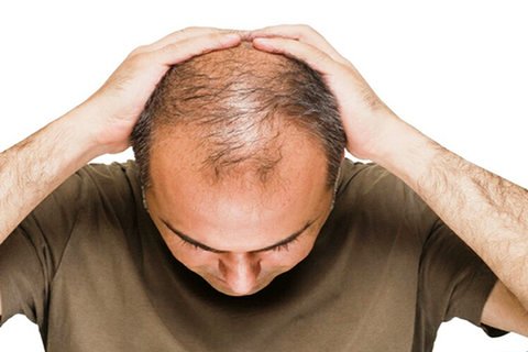 ریزش مو یکی از عوارض بیماری کووید ۱۹