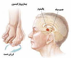 پارکینسون، بیماری شایع تخریبی مغز