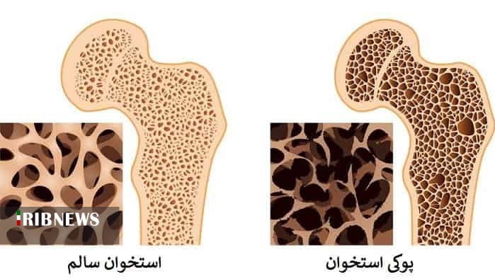 نقش تغذیه در پیشگیری از پوکی استخوان