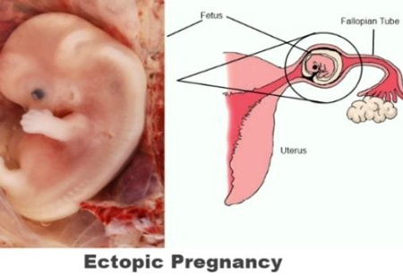 حاملگي خارج رحمی