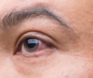 علائم افزایش فشار چشم را بشناسید