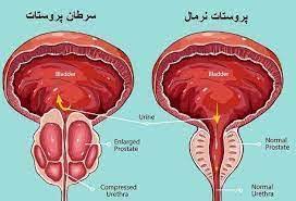 پروستاتیت و راههای درمان آن