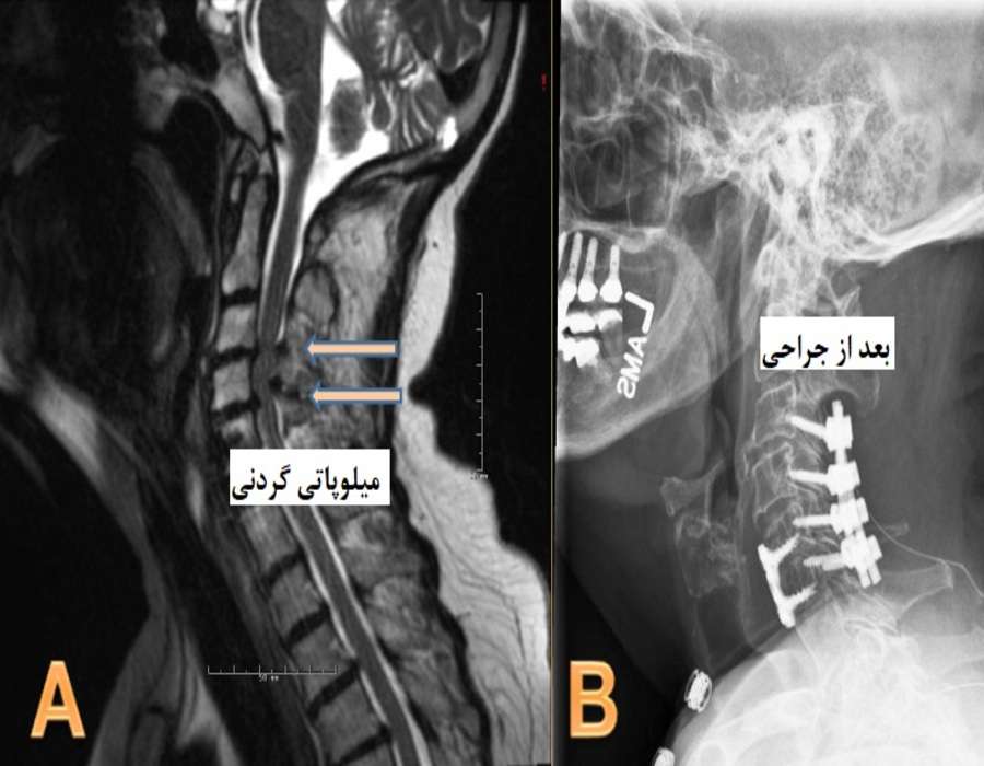 آرتروز گردن را جدی بگیرید