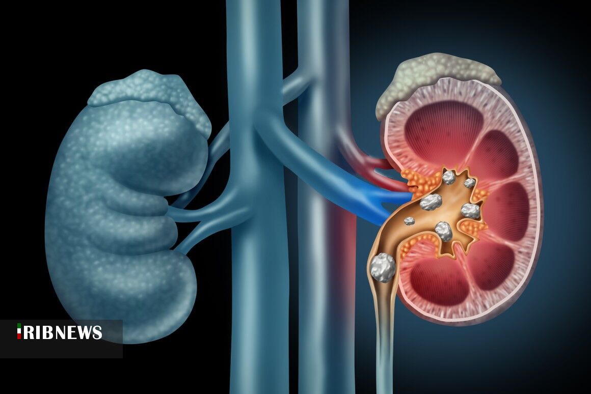 علایم سنگ کلیه و راهکار درمان آن