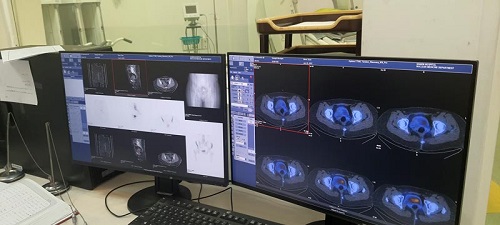 درمان موفقیت آمیز تومور مغزی نوع ۴ با استفاده از نوعی رادیو دارو در مشهد