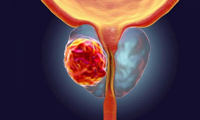 نشانه‌ها و راه‌های درمان سرطان «پروستات» را بشناسید