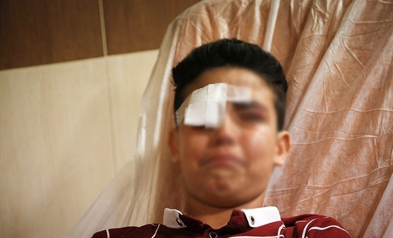 ترقه چهارشنبه سوری، سلامت چشم یک نوجوان را گرفت