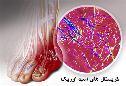 راه تشخیص و درمان بیماری نقرس