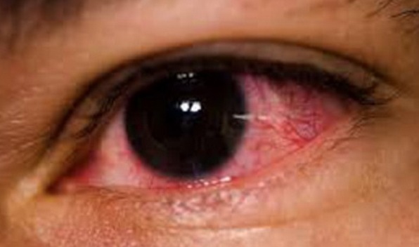 قرمزی چشم چگونه درمان می‌شود؟