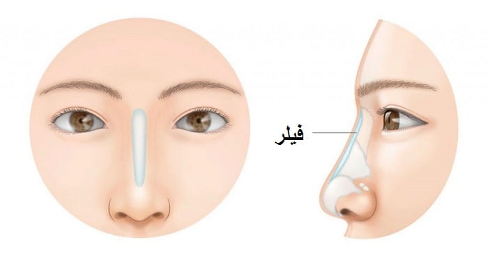 دانستنی‌هایی درباره فیلر بینی