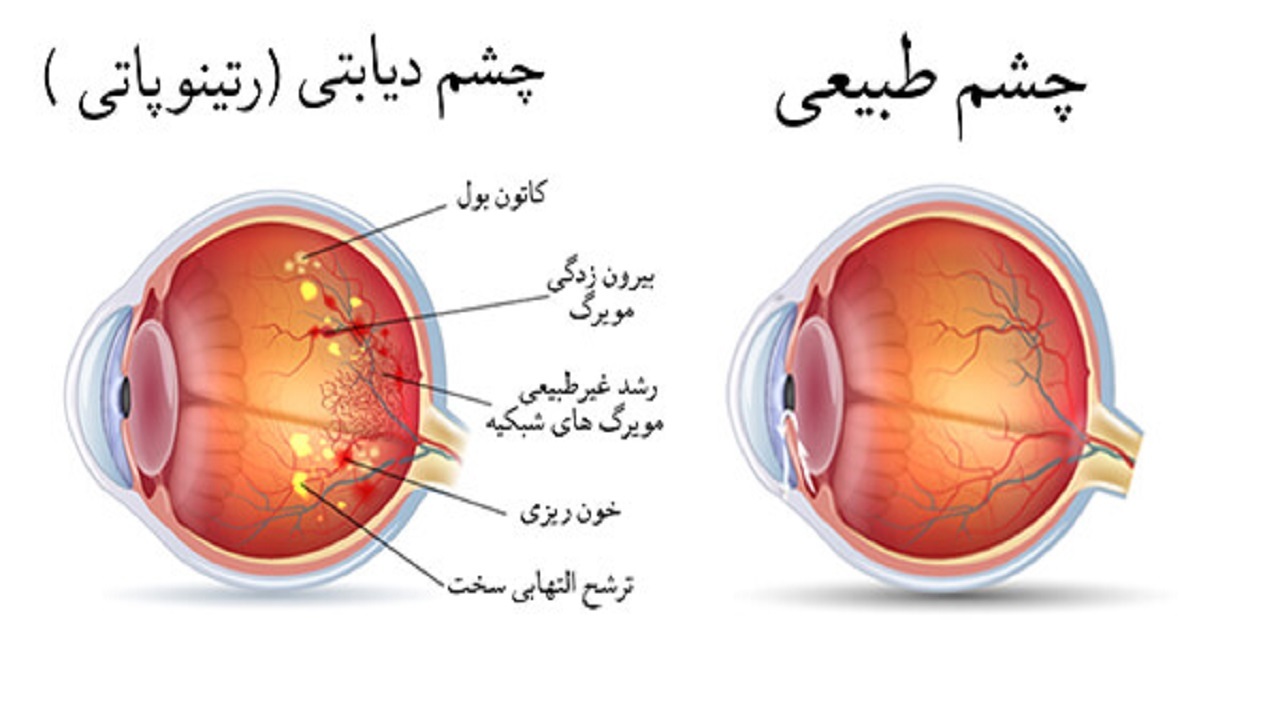 دیابت بیشترین تغییرات را در شبکیه چشم ایجاد می‌کند