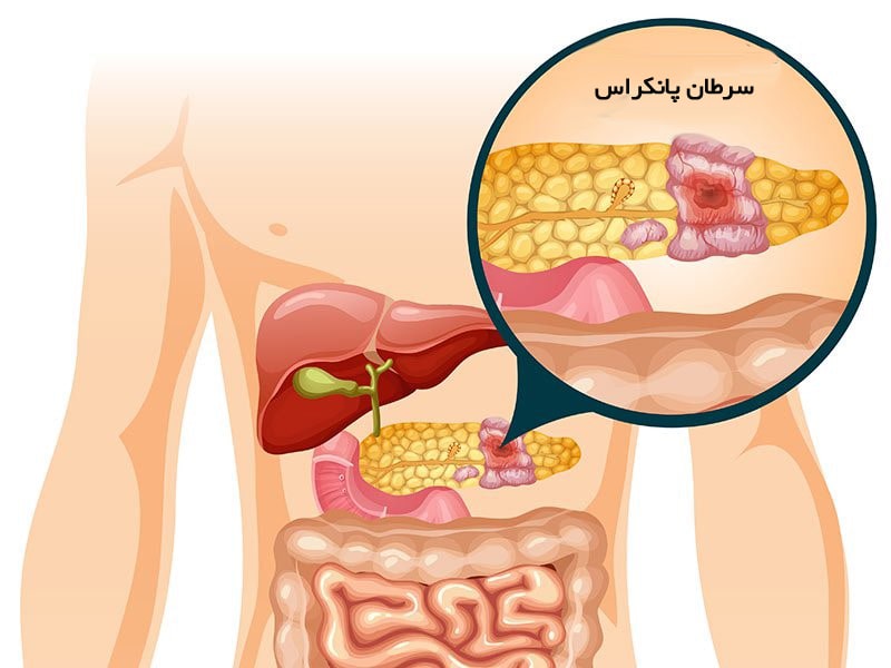 علائم اصلی سرطان پانکراس