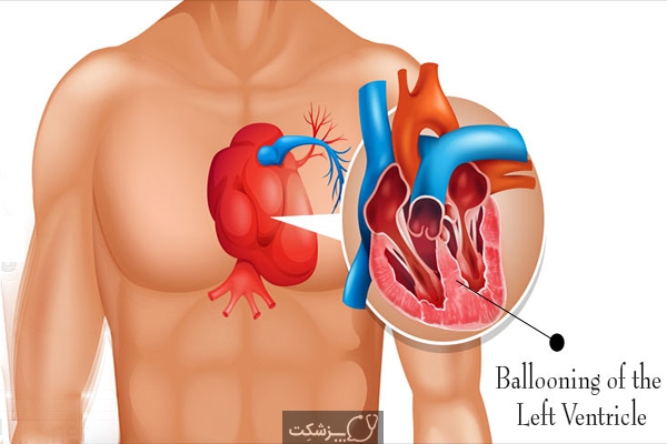 دلیل بروز سندرم قلب شکسته چیست؟