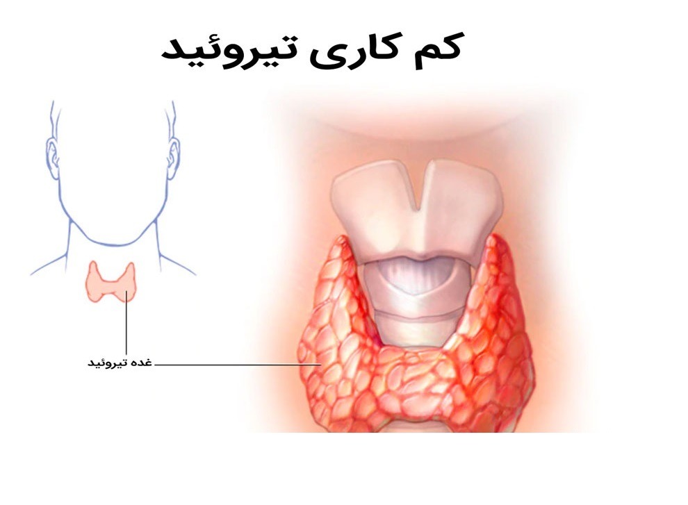 با کم کاری مادرزادی تیروئید بیشتر آشنا شویم!