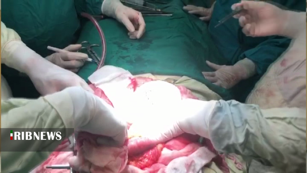 عمل جراحی نادر کلیه در اردبیل