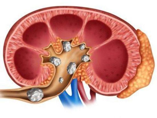 علت سنگ سازی کليه