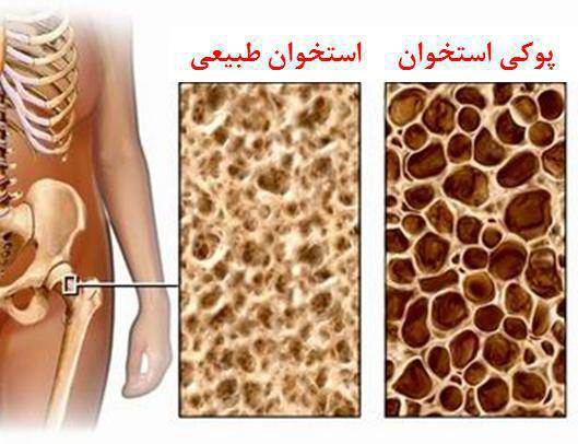 پیشگیری از پوکی استخوان با مصرف کلسیم