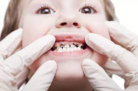 علل پوسیدگی دندان‌های کودکان