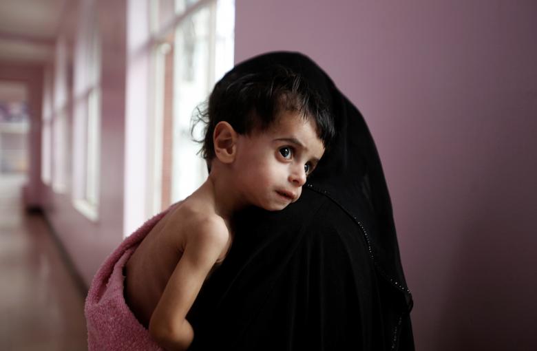سوء تغذیه و نیاز به درمان بیش از ۷ میلیون یمنی