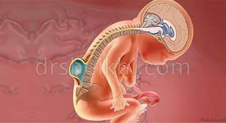 ارائه جدیدترین دستاوردهای علمی درباره بیماری میلومننگوسل