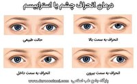 عوارض و درمان انحراف چشم +گزارش