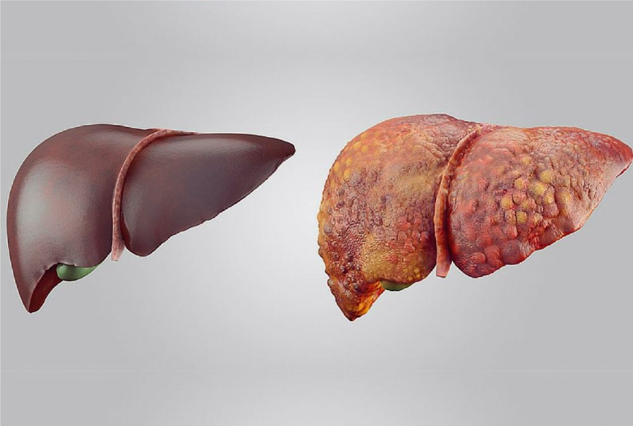 خطر سرطان کبد با چند عادت غلط