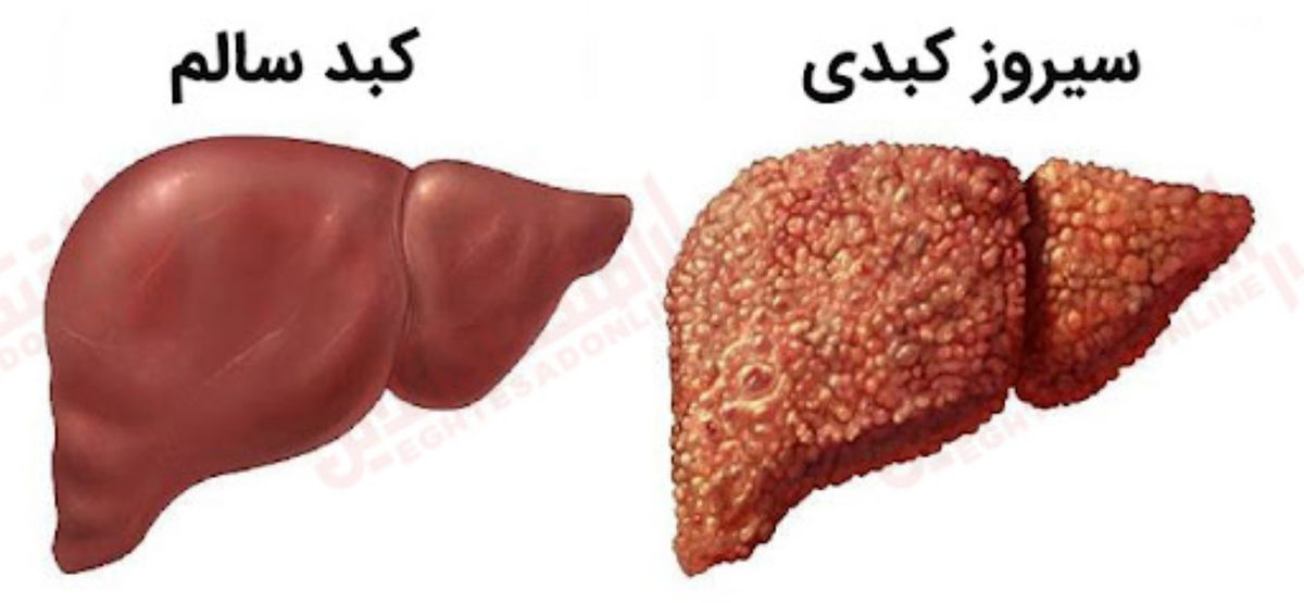 سیروز کبدی دقیقاً چه کار می‌کند