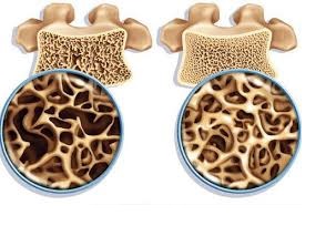 چگونه می‌توانیم خطر ابتلا به پوکی استخوان را کاهش دهیم؟