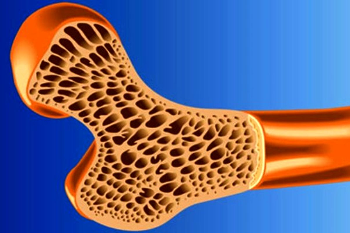 زنان چهار برابر مردان در معرض خطر پوکی استخوان هستند